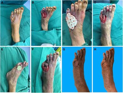 Repairing tendon-exposed wounds by combing the Masquelet technique with dermoplasty